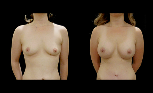 Before & After images of a Breast Augmentation