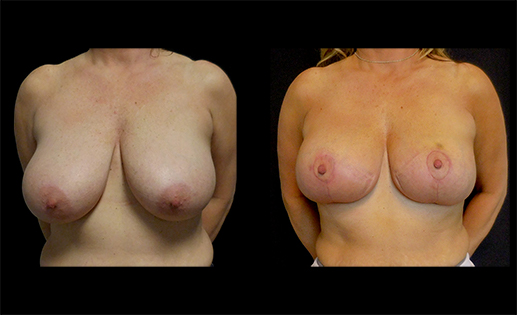 Before & After images of a Mastopexy