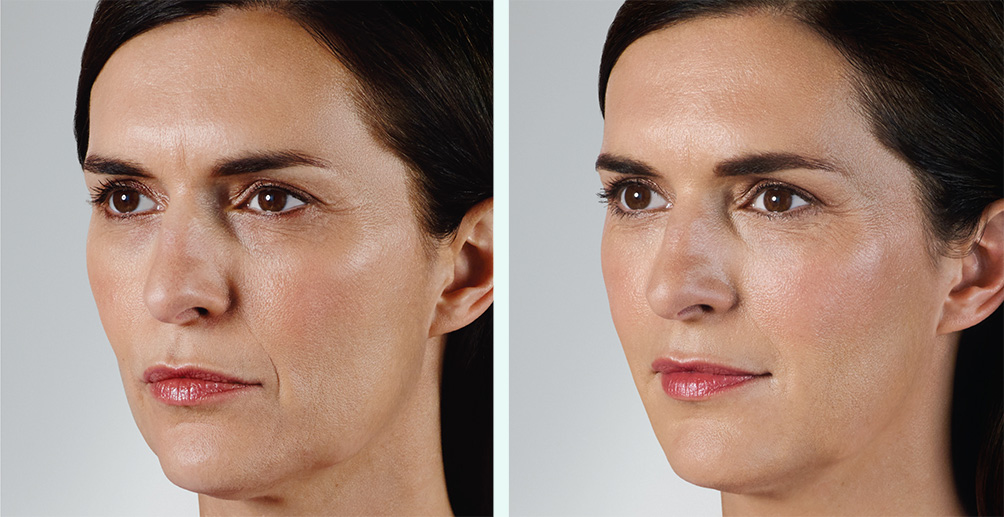 Before & After with JUVEDERM® Ultra XC