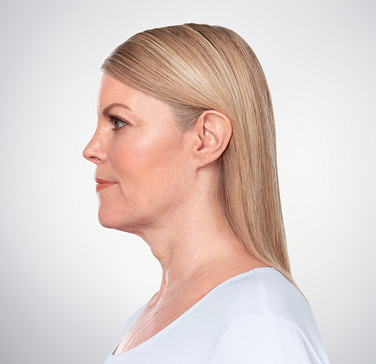 Image After 3 treatments with Kybella