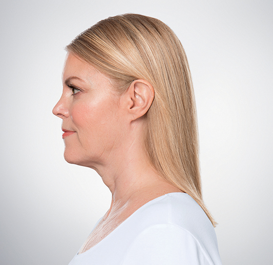 Image After 4 treatments with Kybella