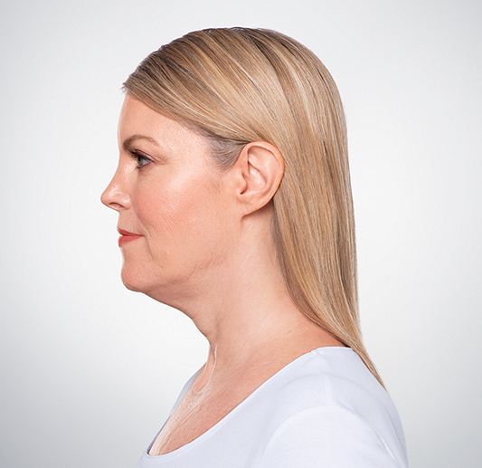 Image Before Kybella Treatment